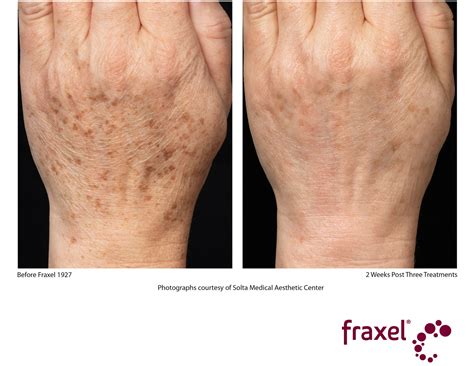Fraxel Dual Laser Resurfacing .